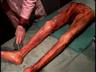Human Anatomy Dissection 20 Superficial Limbs